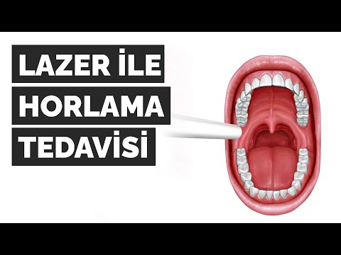 LAZER İLE HORLAMA TEDAVİSİ | NIGHTLASE | SNORLAZE | M.SC.DT. ZAFER KAZAK
