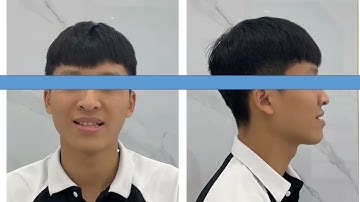 Case lâm sàng siêu khó với hạng 3 cắn ngược, lệch xương hàm dưới kèm chen chúc.