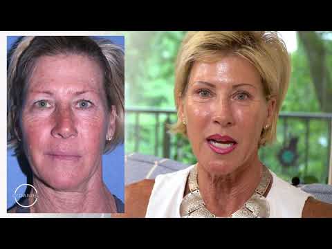 Allison — Brow lift