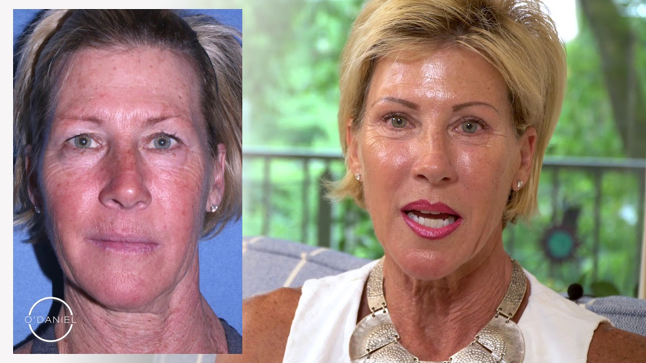 A browlift patient's real story