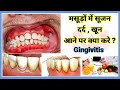 मस ड म स जन और दर द क इल ज मस ड म दर द क इल ज Gingivitis Masudo Ki Sujan Ka Ilaj