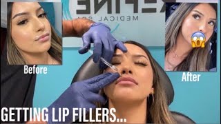 I GOT LIP FILLERS FOR THE FIRST TIME 2020 + Answering your questions!