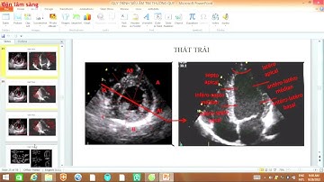 QUY TRÌNH SIÊU ÂM TIM THƯỜNG QUY | ThS. BS. BÙI Vĩnh Hà