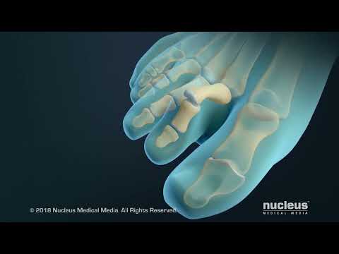 Video: Kaip gydyti įlenktą pirštą: 14 žingsnių (su nuotraukomis)