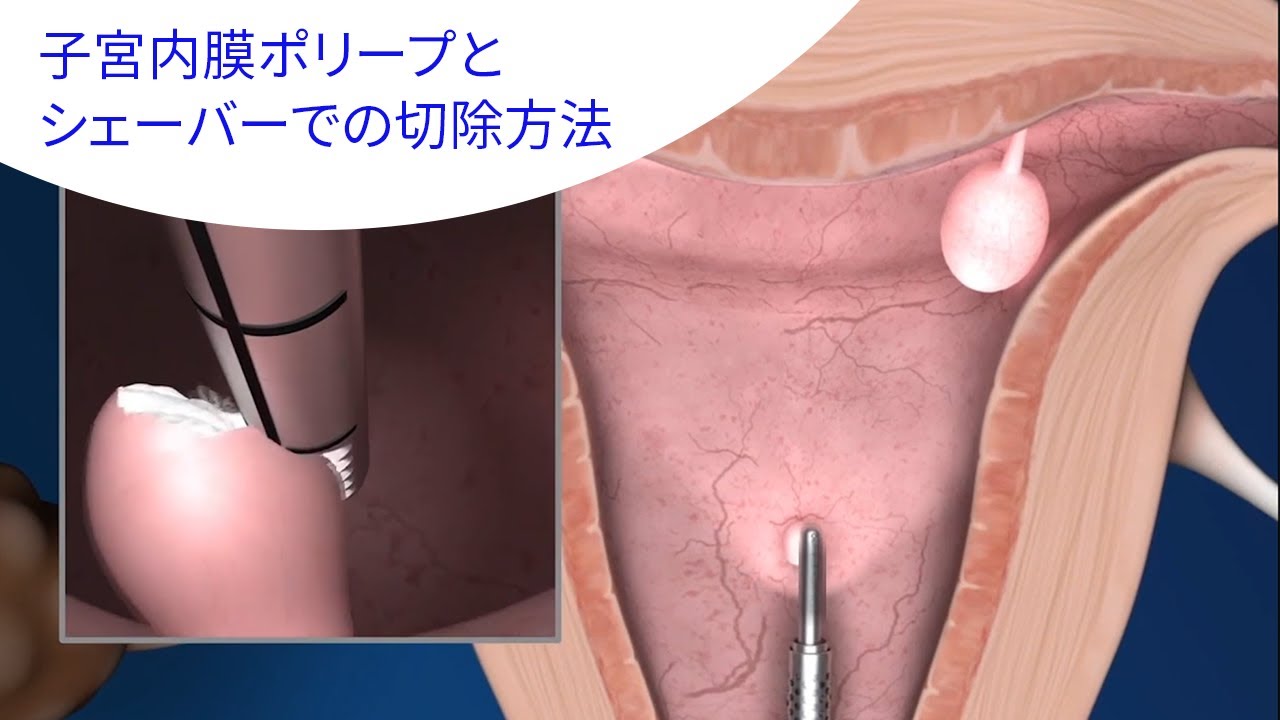 子宮内膜ポリープとシェーバーを用いた切除方法