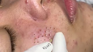 Loan Nguyen Acne Treatment 10u