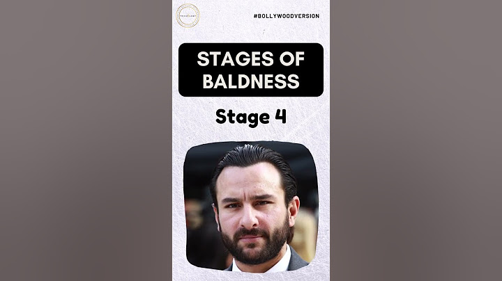 Stages of Baldness Feat. Bollywood Stars | Hair Transplant Clinic | Dadu Medical Centre Trichology