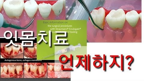 잇몸치료 ( 스케일링, 잇몸치료,  치주수술 ) 언제하지 ?  / 엠도게인 과장광고