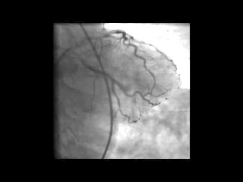 Video: Entwurf Einer Facettenreichen Telemedizin-Intervention Für Eine Ländliche Bevölkerung Unter Verwendung Eines Modells Zur Entwicklung Komplexer Interventionen In Der Krankenpflege