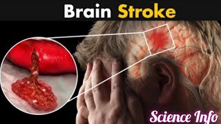 What Happens in Brain Stroke |Ischemic And Hemorrhagic stroke(Urdu/Hindi)stroke brainstroke