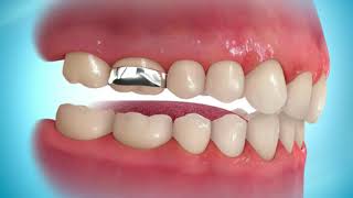Bite Plate Fixed