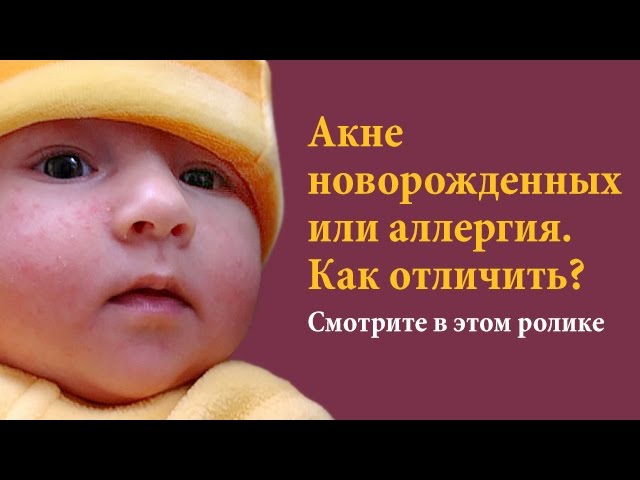 Наконец-то Вы сможете отлечить - Акне новорожденных от аллергии.