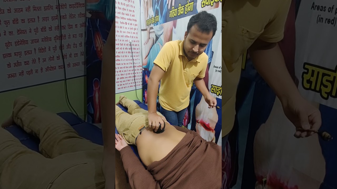 Back pain slip disc treatment fire cupping 🔥🔥🔥 by dr sherwani
