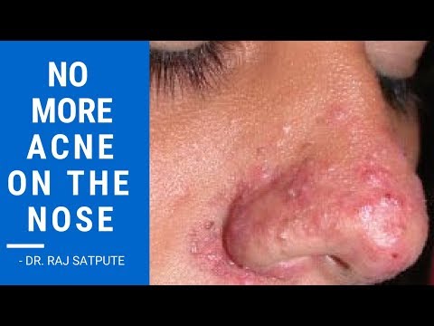 You Will Never Get Pimples On Your Nose If You Follow This