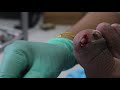 Ep_648 Ingrown nail removal 👣 มาช่วยกันลุ้นนะ 😉 (This video clip from Thailand)
