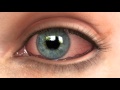 Conjunctivochalasis (CCH) Dry Eye Animation