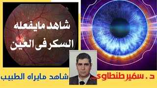 تأثير مرض السكر على العين.مرض السكر والعين. علاج الشبكية