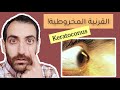 مختبر النظر  حالة شائعة كثيرا في عالمنا العربي القرنية المخروطية