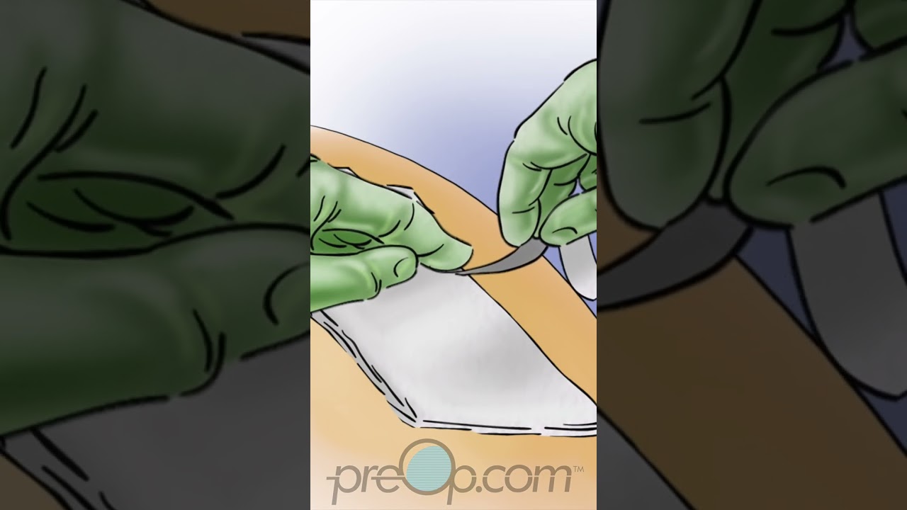 PreOp®🌟 Navigating Through Wound Care 