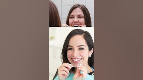 Spark Clear Aligners.mp4