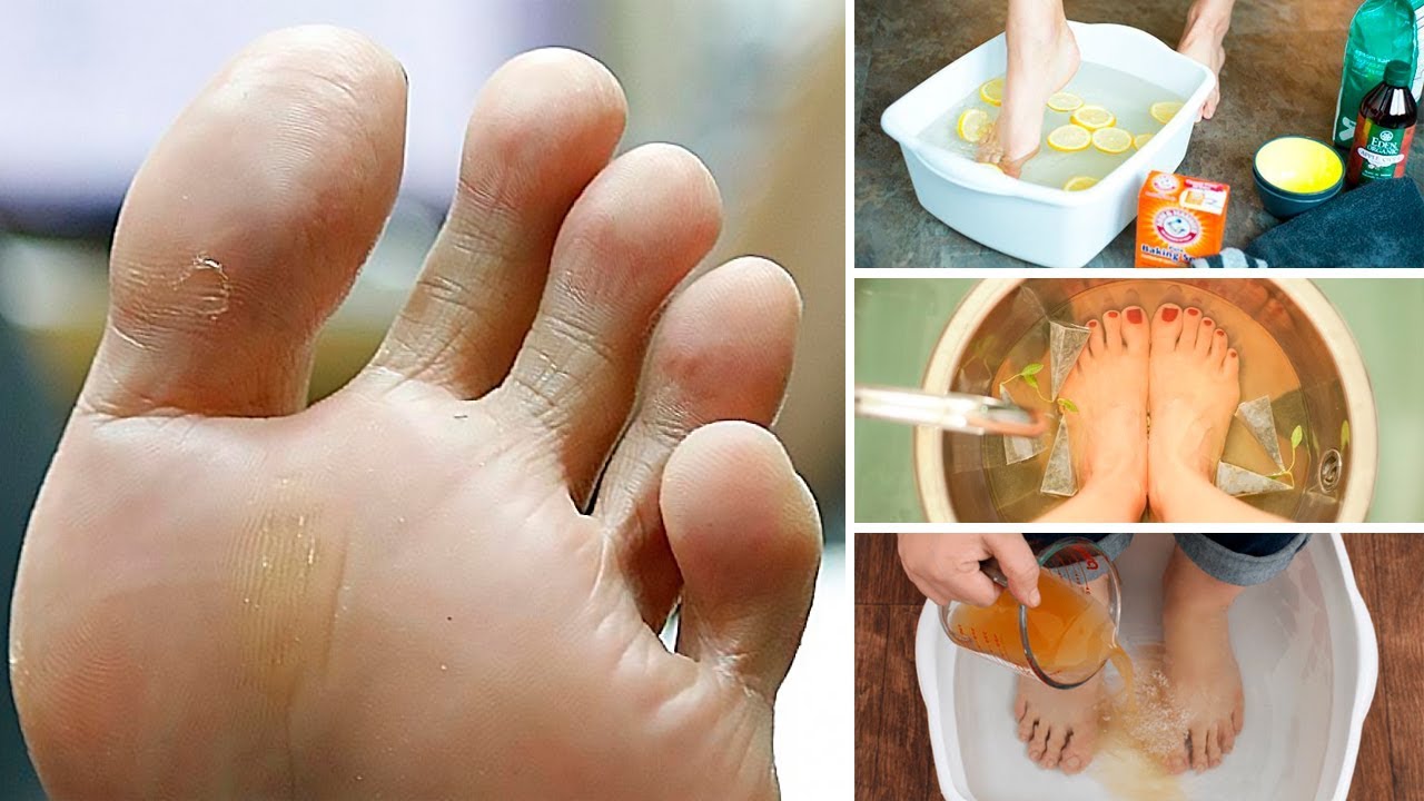 Smelly Feet, Tips on How To Prevent Foot Odour