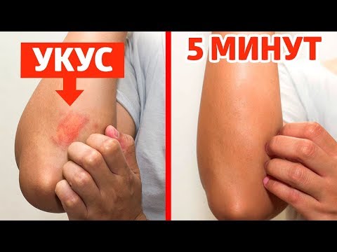 Снять зуд от укусов насекомых в домашних условиях