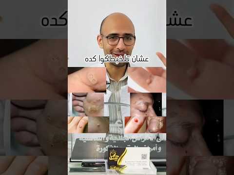انواع السنط و عين السمكة الأسباب و العلاج      