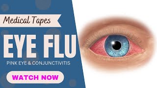 Eye Flu |Conjunctivitis|Pink Eye|Symptoms|Prevention|Virus|Medicine