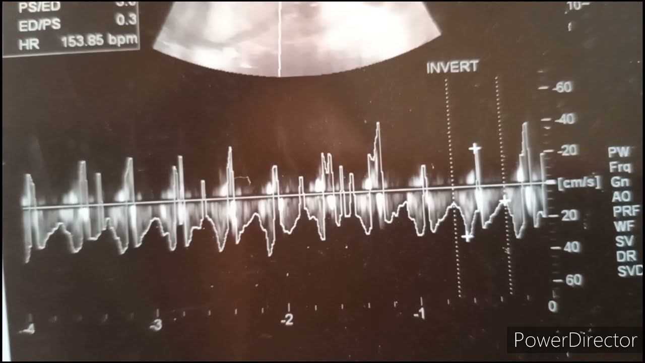 Level 2 usg(ANOMALY SCAN) Maturity of baby weight,  Heartbeat & Activities in level 2/Everything