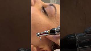 Dry Needling TMJ