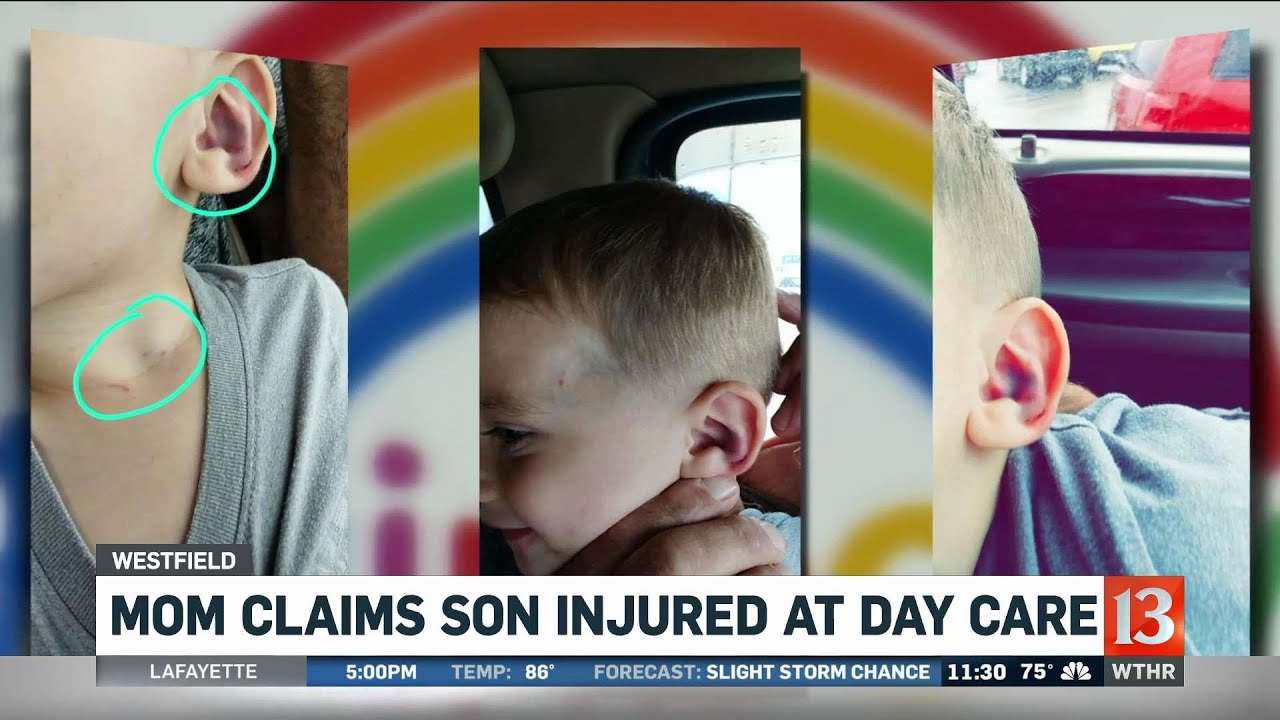 Daycare Child's Injuries - YouTube
