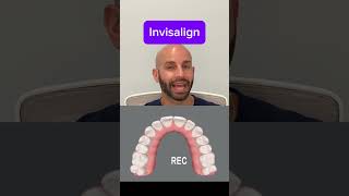 Invisalign case explained by orthodontist specialist