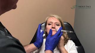 Juvederm Voluma Treatment Video