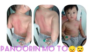 Bakit Tayo Nagkakaroon Ng Pantal Sa Katawan?