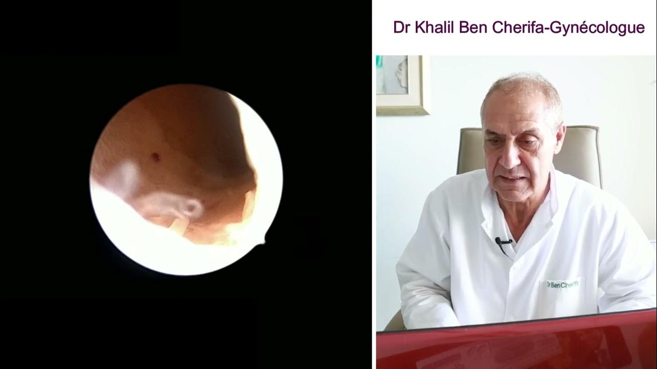 Hystéroscopie Diagnostique Endométrite Chronique et Adénomyose YouTube