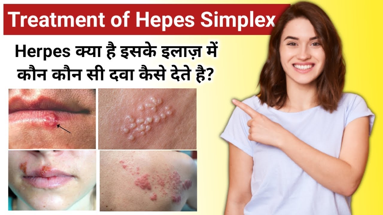 Herpes Simplex Kya Hai Treatment Of Herpes Simplex Acyclovir 400mg herpes-simplex-kya-hai-treatment-of-herpes-simplex-acyclovir-400mg