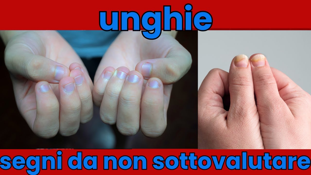 UNGHIE: segni sulle unghie da non sottovalutare - YouTube