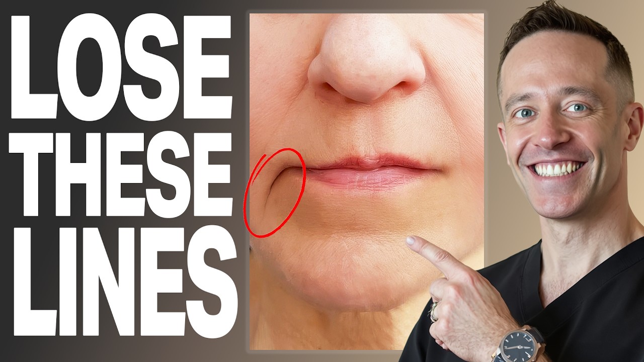 ПРАВДА о филлерах для коррекции морщин марионетки (руководство врача)