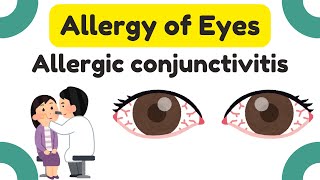 Eye Allergy | Allergic conjunctivitis of Eyes | Eye infections