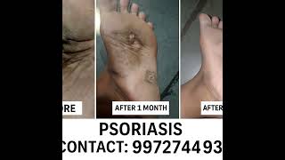 Ringworm treatment #ringworm #skincare #skincaretips #ayurvedacure #gajakarna #healthylifestyle #vir