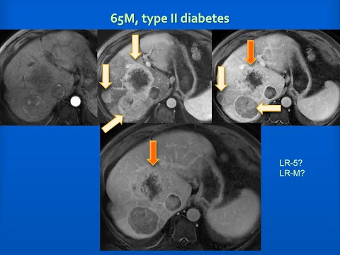 Hepatocellular Carcinoma Imaging: LI-RADS; ***updated version at: https://youtu.be/qmlhWFeDu_o