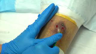 Thorny's Leg Abscess?  Extended Raw Cut by Meta-Seven