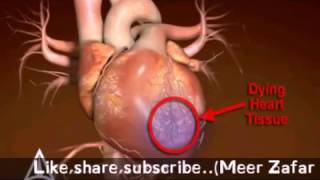 SHAPE  Heart Attack PSA  3D Medical Animation