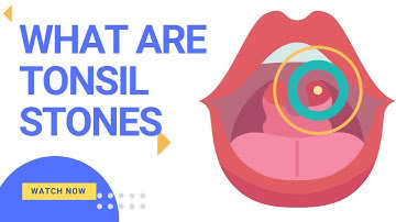 What Are Tonsil Stones? How Do They Work?