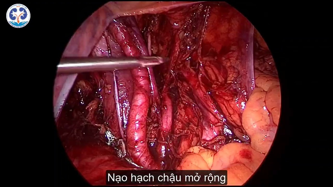 HUNA 2024 - PHẪU THUẬT NỘI SOI CẮT TUYẾN TIỀN LIỆT TẬN GỐC T3