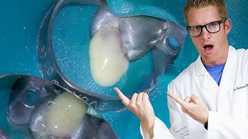 Root Canal Procedure with OOZING PUS Done By A Dentist with Step-By-Step Guide to Treatment