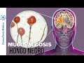 La Mucormicosis  comúnmente llamada &quot;Hongo Negro&quot; 👨‍⚕️ Consultorio Médico