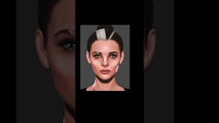 WAARDENBURG SYNDROME #shorts