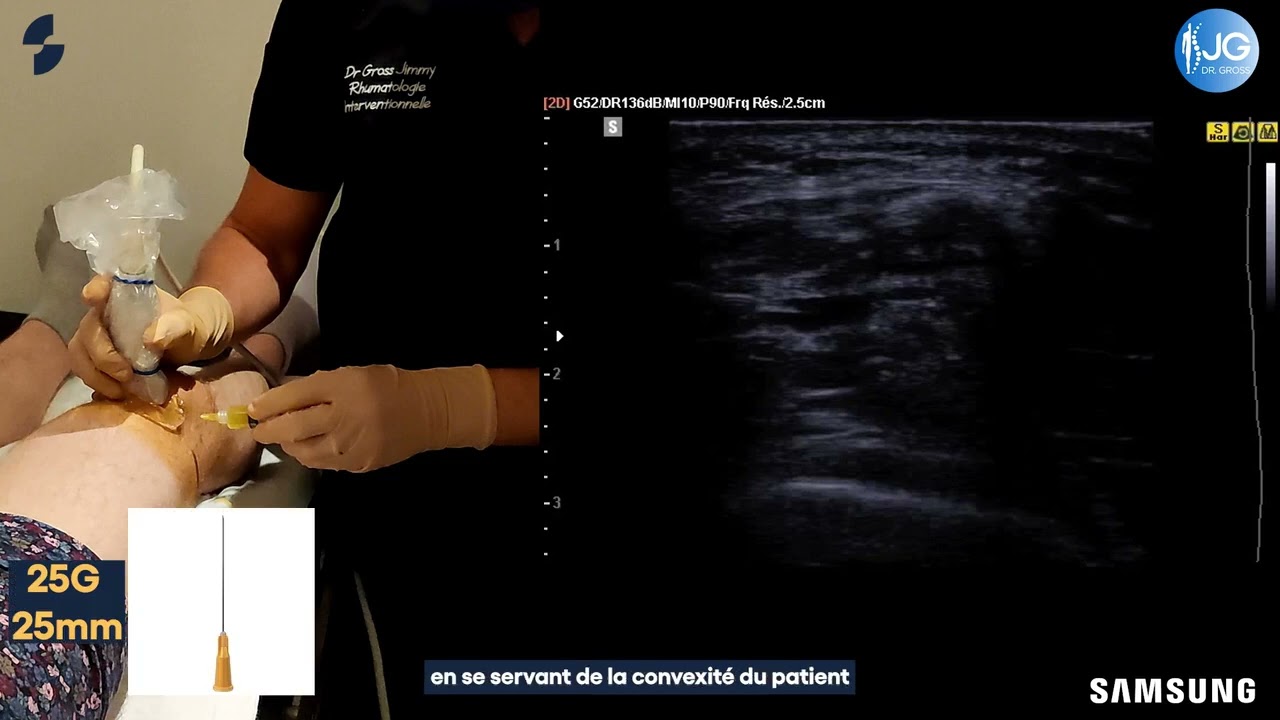 Comment j'infiltre un GENOU et le MENISQUE MEDIAL