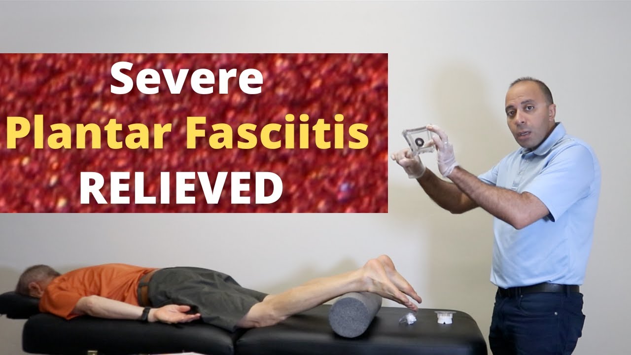 Unbearable Severe * Plantar Fasciitis * Pain RELIEVED (+FollowUp